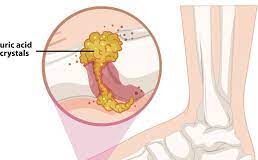 Gout Symptoms and Treatment