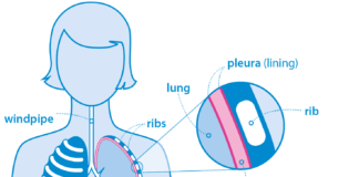Cancer Symptoms and Treatments