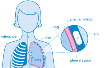 Cancer Symptoms and Treatments