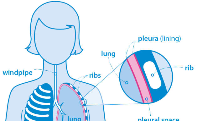 Cancer Symptoms and Treatments