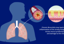 Flash Bronchitis Causes, Symptoms, Deaths and Impact