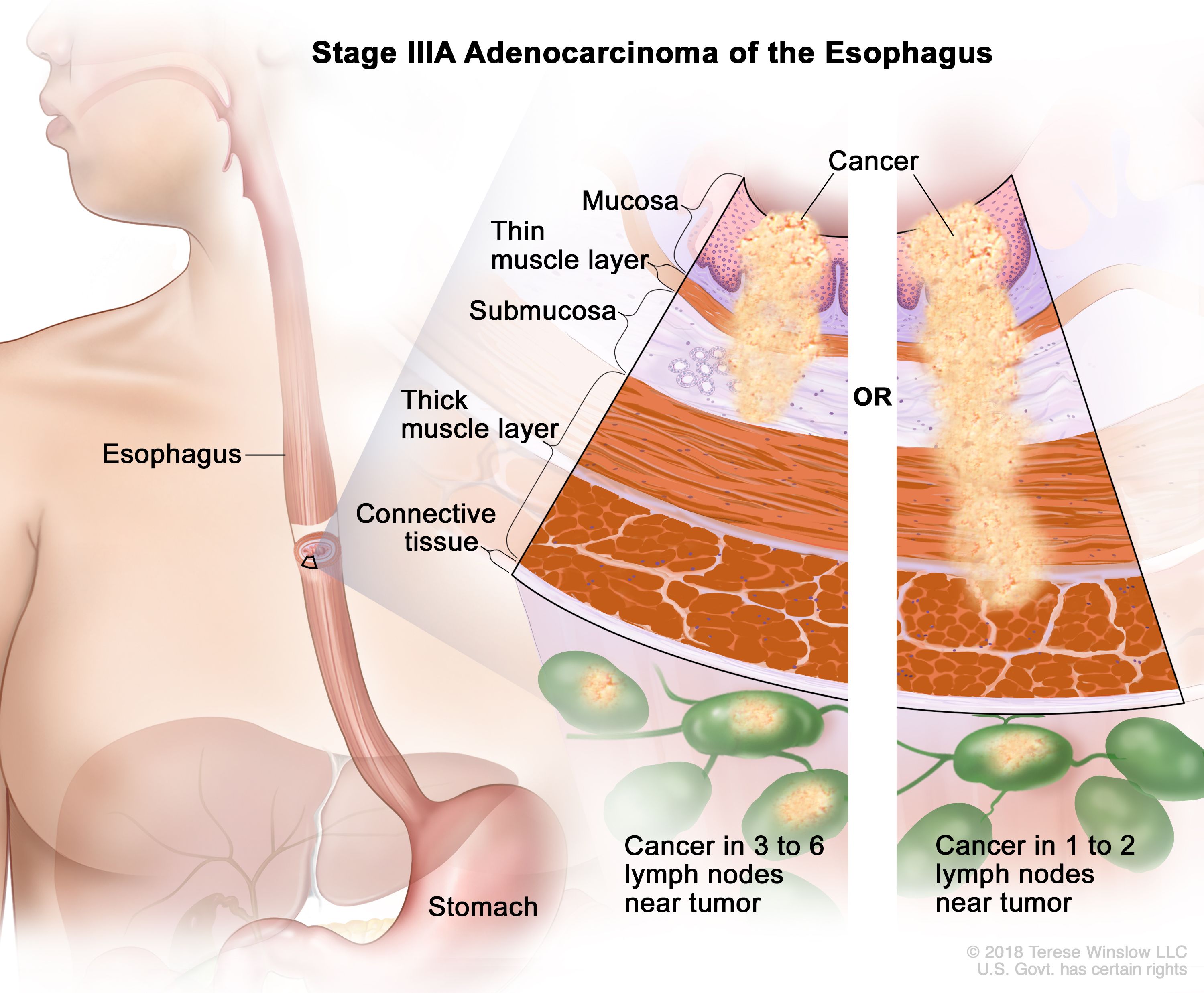Esophageal Cancer Symptoms and Treatments