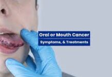 Tongue Cancer Symptoms and Treatments