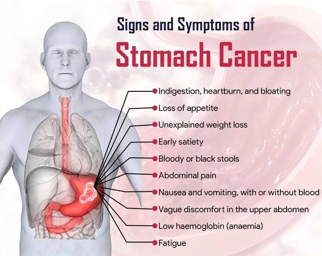Stomach Cancer Symptoms and Treatments