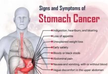 Stomach Cancer Symptoms and Treatments